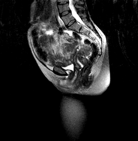 Pelvic Floor MRI scan 1